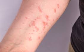 Município de São Bento confirma o 1º caso de Varíola dos Macacos