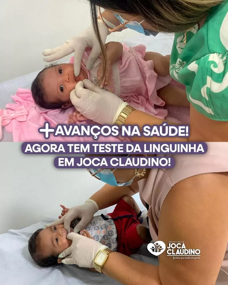 Prefeitura de Joca Claudino implanta Teste da Linguinha na rede municipal de saúde